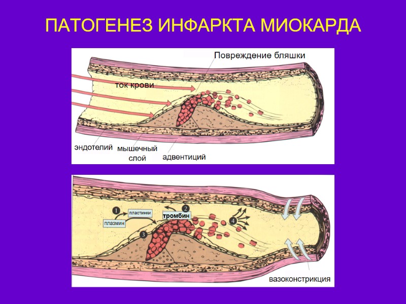 ПАТОГЕНЕЗ ИНФАРКТА МИОКАРДА  ток крови Повреждение бляшки эндотелий мышечный слой адвентиций  